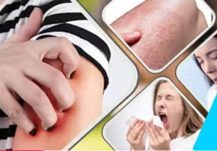 রক্তে এলার্জি কারণ লক্ষণ ও চিকিৎসা।